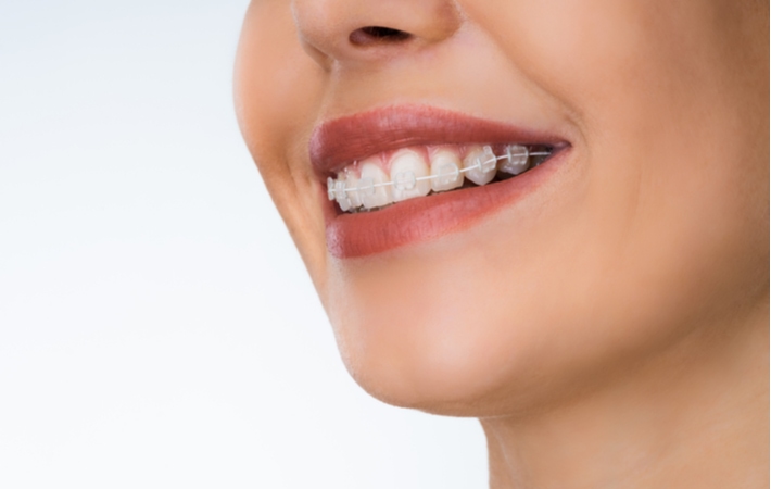 A close up of a woman with clear 6-month smile braces