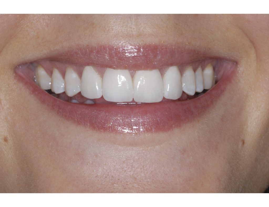 After photo close up of teeth with veneers