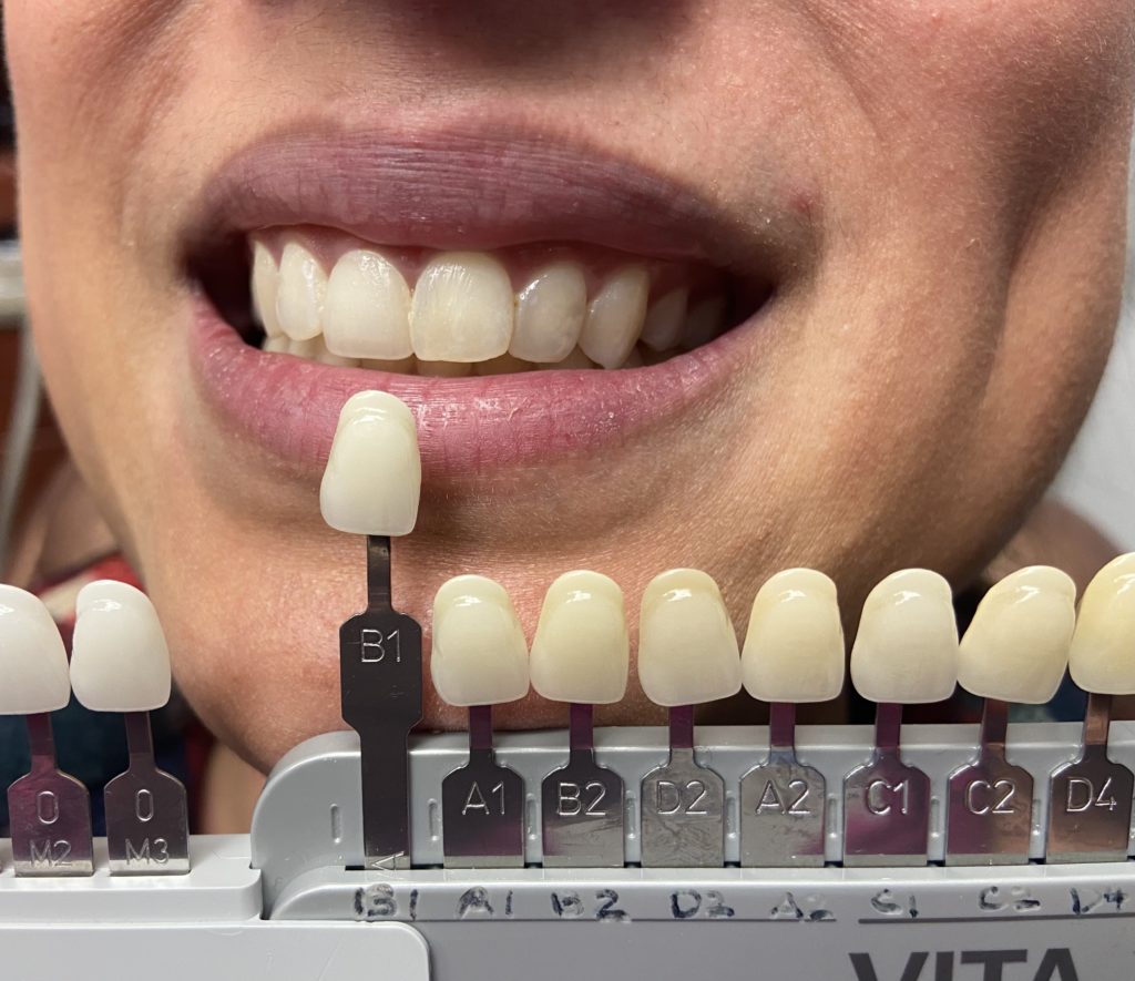 Dental patient selecting the right shade of white for veneers