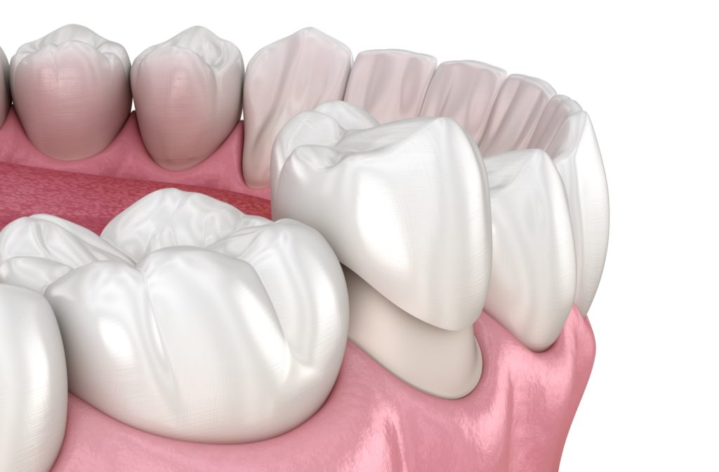 A 3D rendering of a dental crown being placed