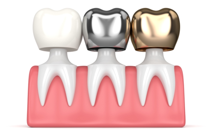 A 3D illustration of 3 different types of dental crowns