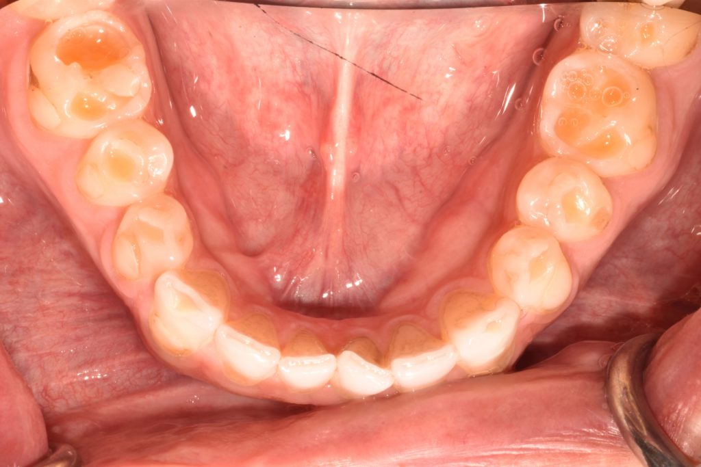 A close-up view of someone's upper jaw experiencing the effects of erosion on their teeth