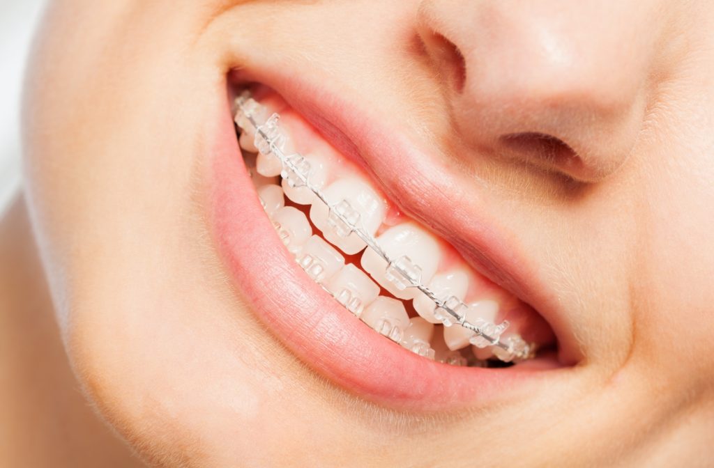 A close up of a woman wearing braces smiling with clear brackets