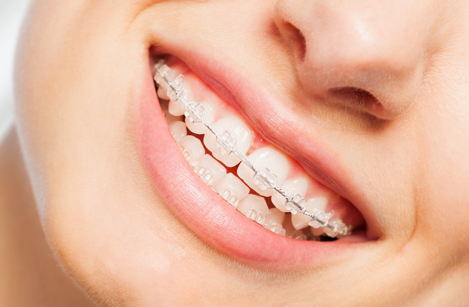 How to Speed Up Your Braces Process
