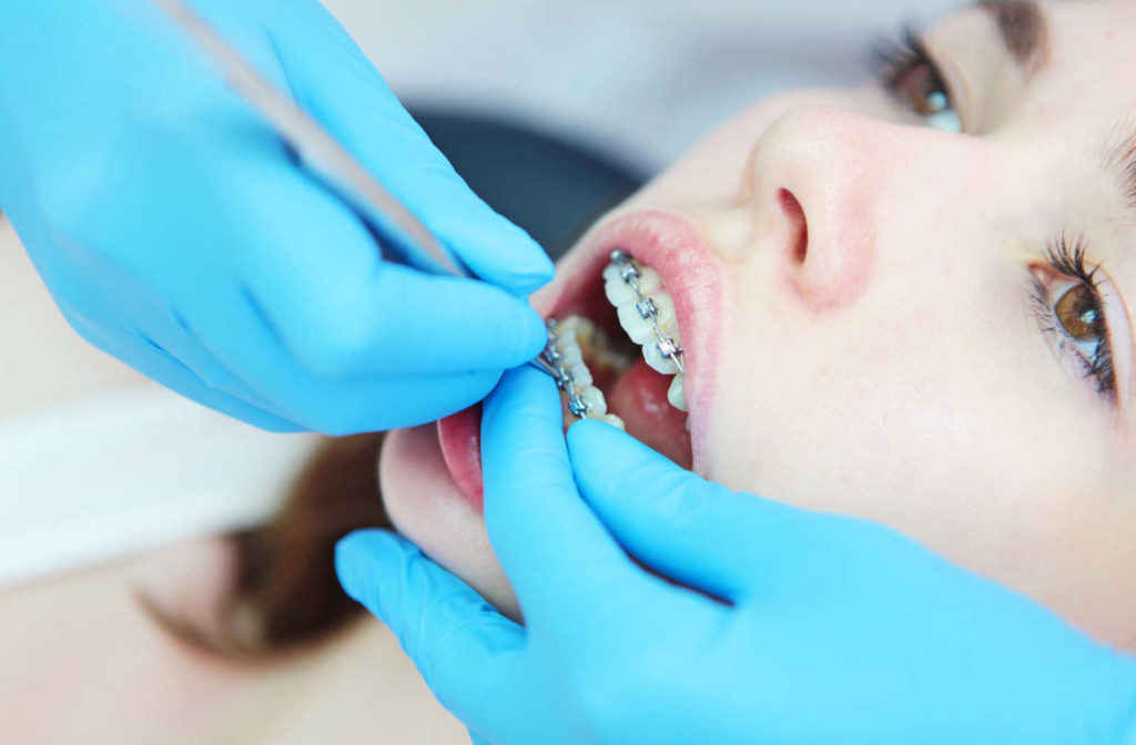 A young girls having her teeth cleaned while wearing braces.
