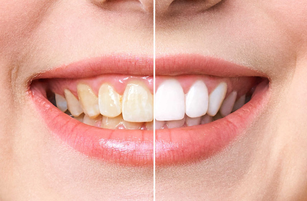 A close up of a smile showing the before and after affects of a teeth whitening treatment