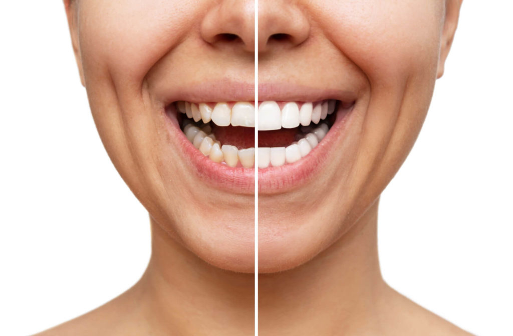 A close-up of woman's mouth with before and after getting a dental veneers