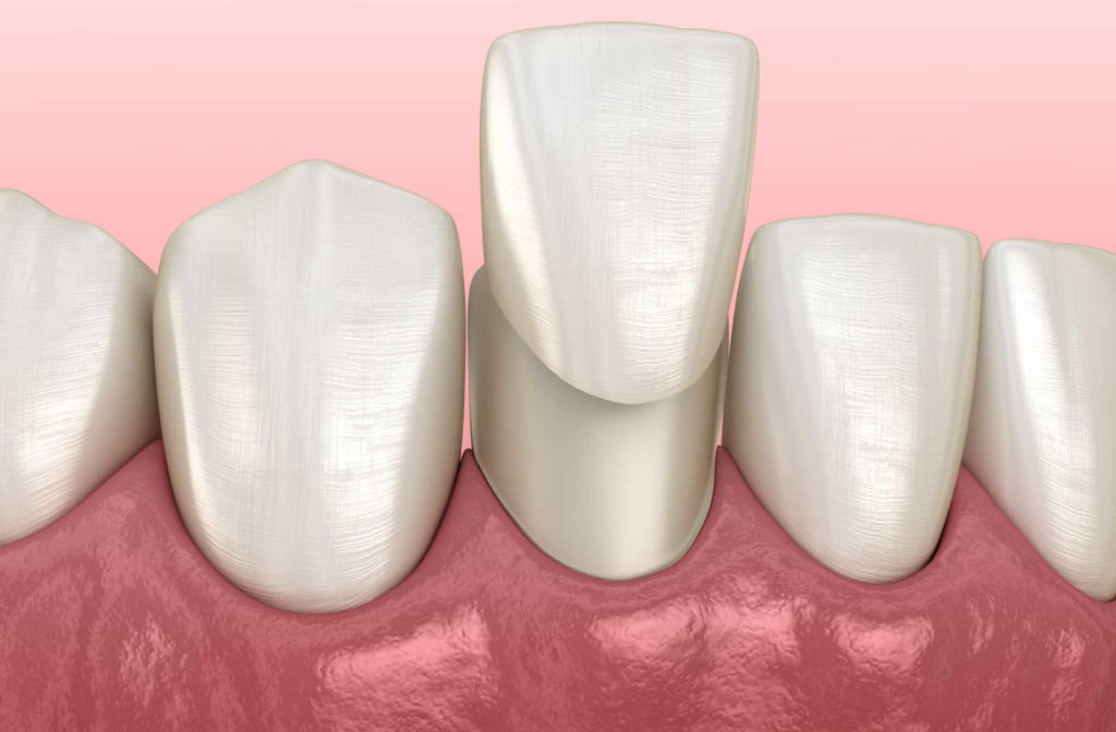 A rendered image of a veneer ready to be place over top of the prepared natural tooth