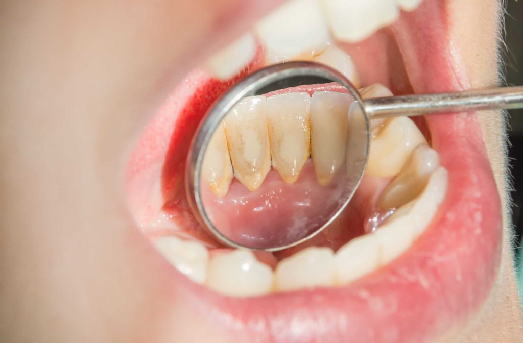A hand-held dental mirror in a patients mouth showing plaque build-up