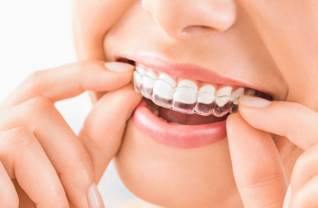 A close up of a person putting in their Invisalign clear aligners while smiling