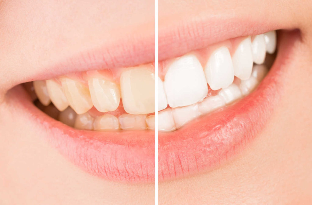 A close-up of a smile with half the teeth on the left being yellow and the other half of the teeth on the right being white