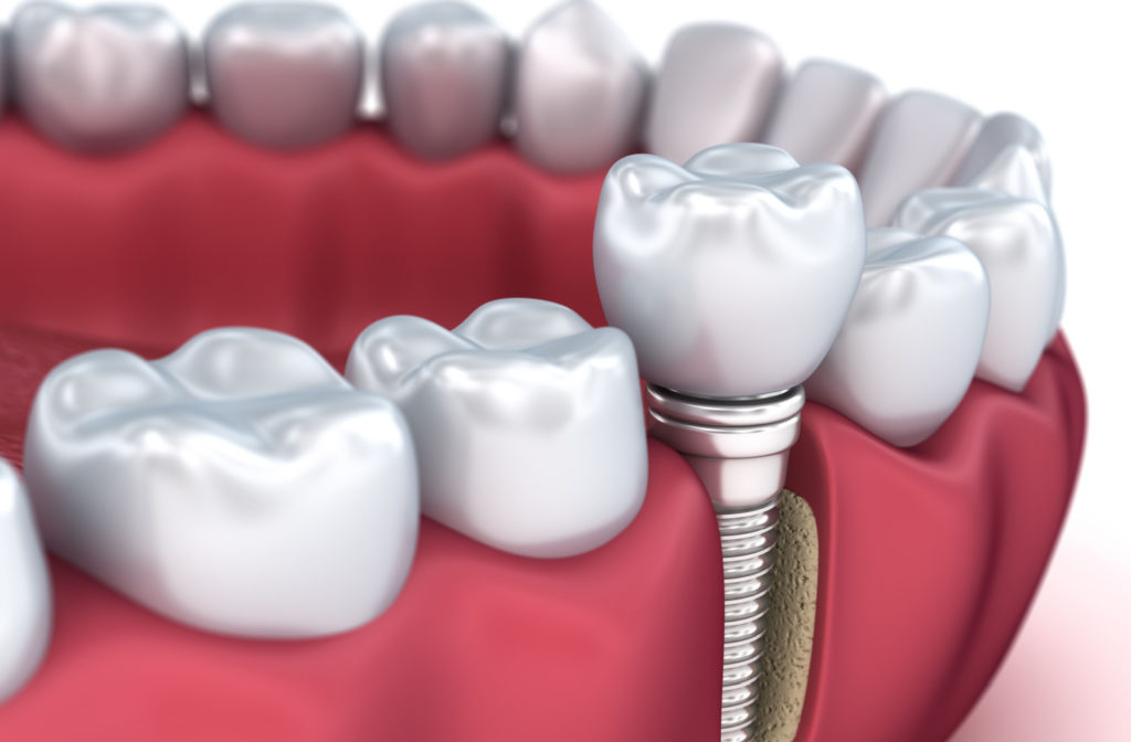 An animated image of a dental implant showing the titanium anchor and crown on top.