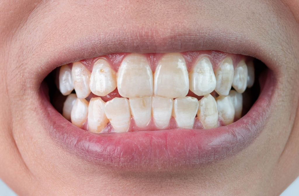 A close up of a person's mouth showing teeth with white spots.