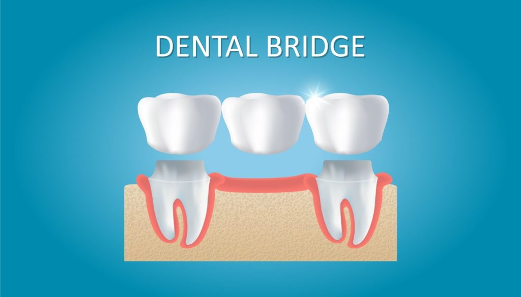 An image displaying a dental bridge being used to replace a missing tooth.
