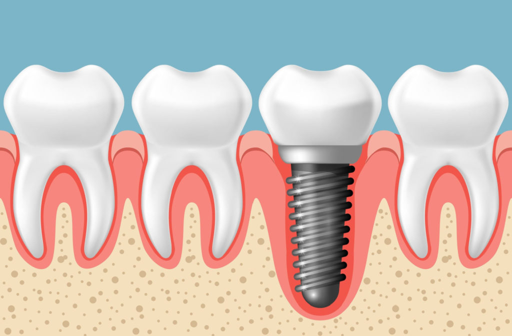 An image of a dental implant showing the titanium post that has placed in the jaw bone to mimic a tooth root.