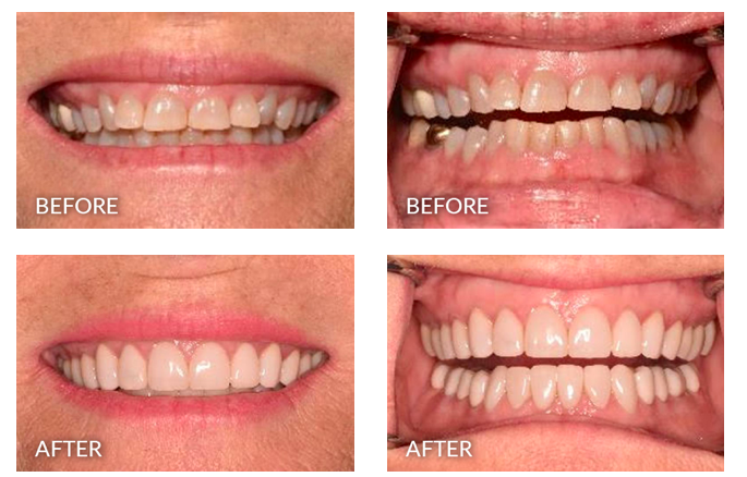 A before and after example of a patient with tooth wear or dental attrition from severe bruxism. The after treatment included Invisalign and dental crowns.