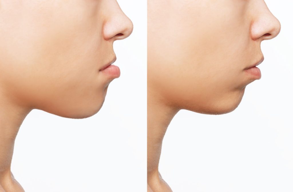 A photo of two different face profiles to showcase how a person's chin might look like if they have an underbite vs. if they have an overbite.