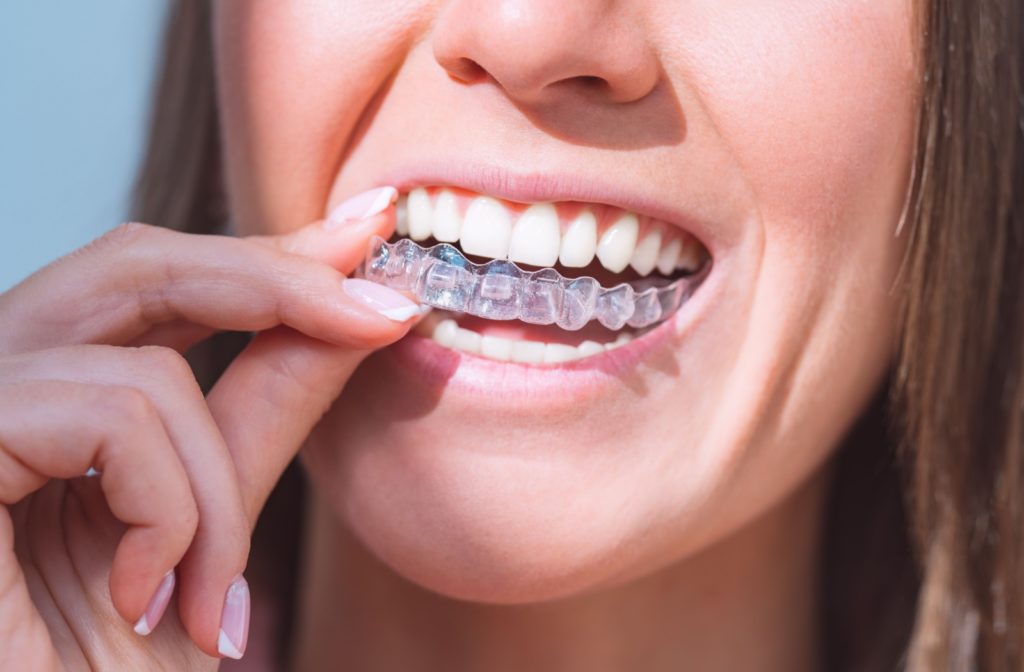 A close up of a person putting an Invisalign aligner in their mouth