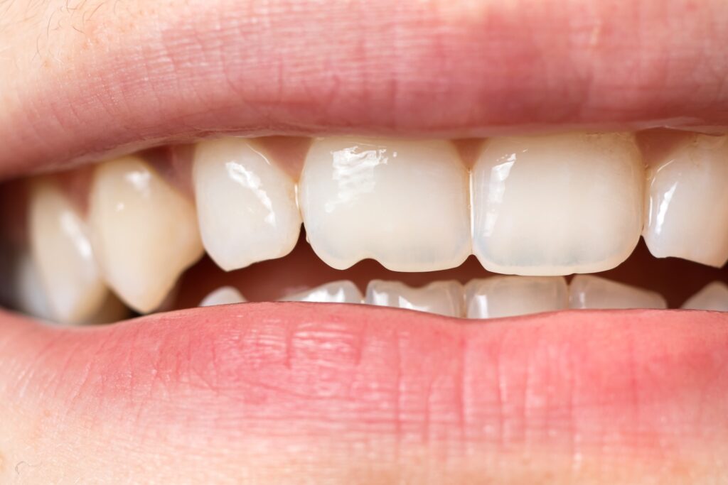 A close up of a chipped front tooth.