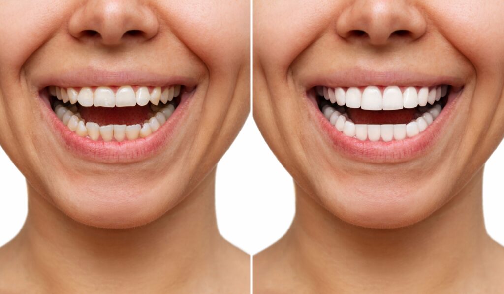 A before and after of a patient with no veneers versus with dental veneers.