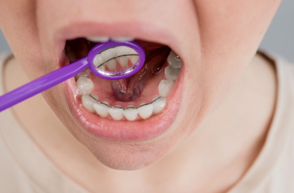 A wire retainer behind the bottom teeth of a patient who had orthodontic treatment.