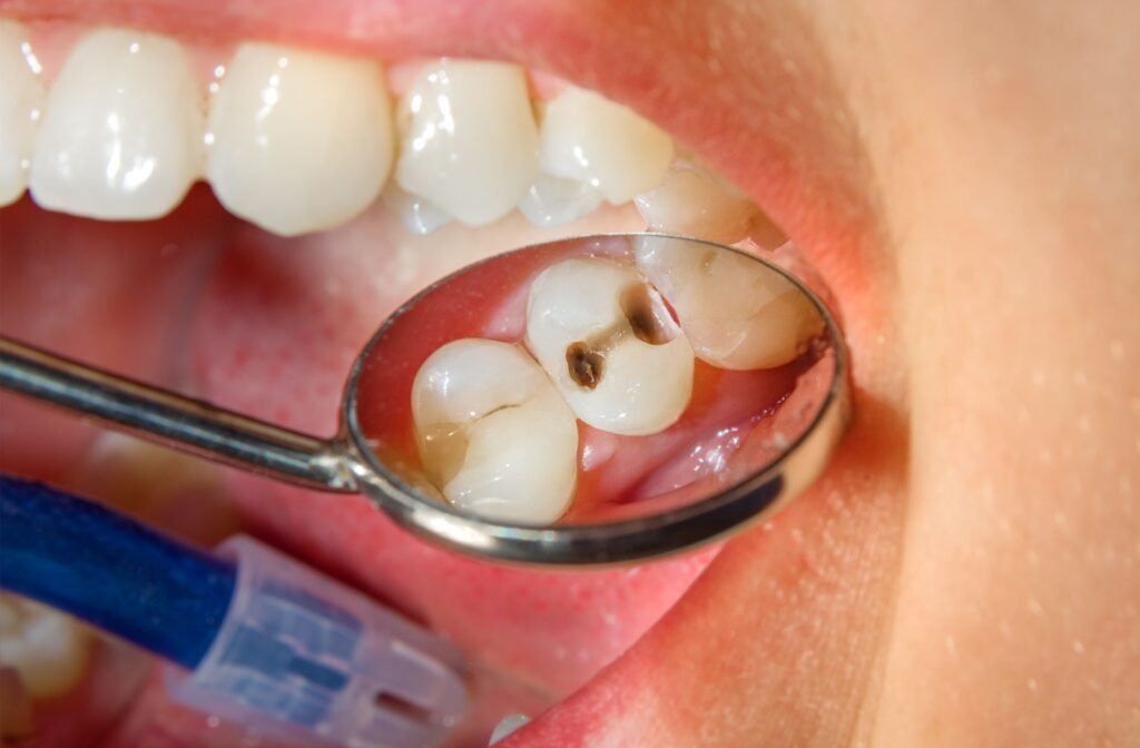 A close up look of a dental cavity in a patient's mouth