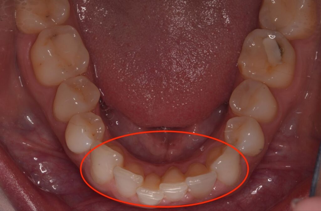 A birds eye view of a lower arch with moderate mesial drift.