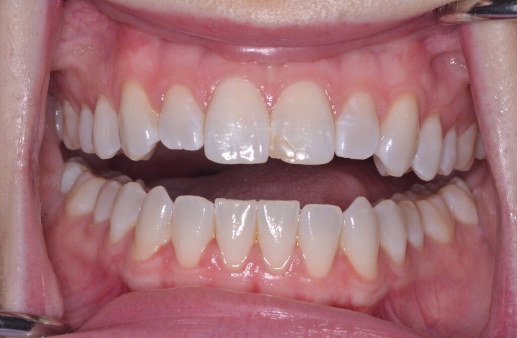 A straight on view of a smile with mild mesial drift