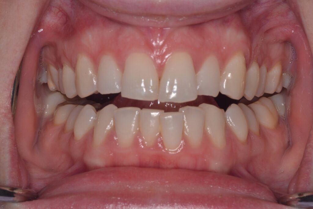 A straight on view of a smile with moderate mesial drift.