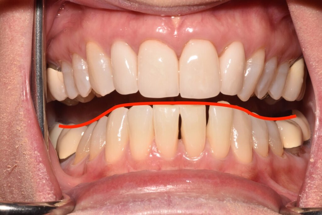 A close up of a smile showing the curve of Spee.
