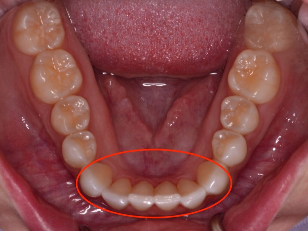 A birds eye view of a lower arch with mild mesial drift