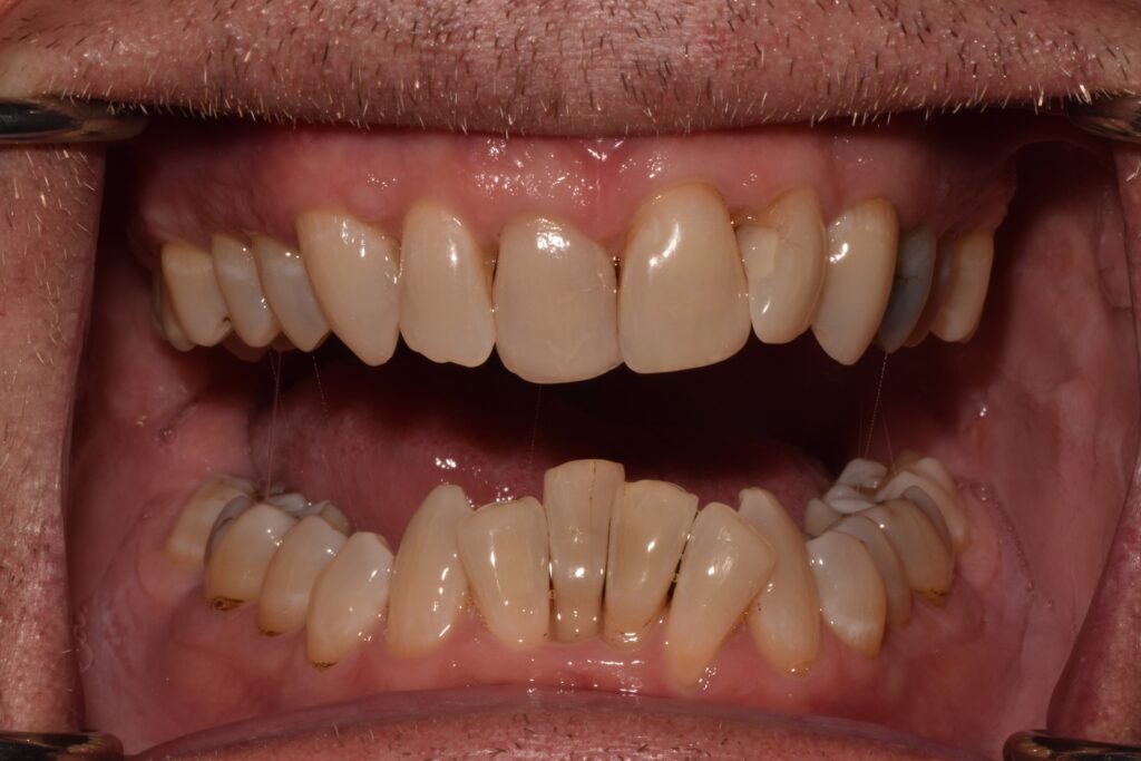 A straight on view of a smile with severe mesial drift.