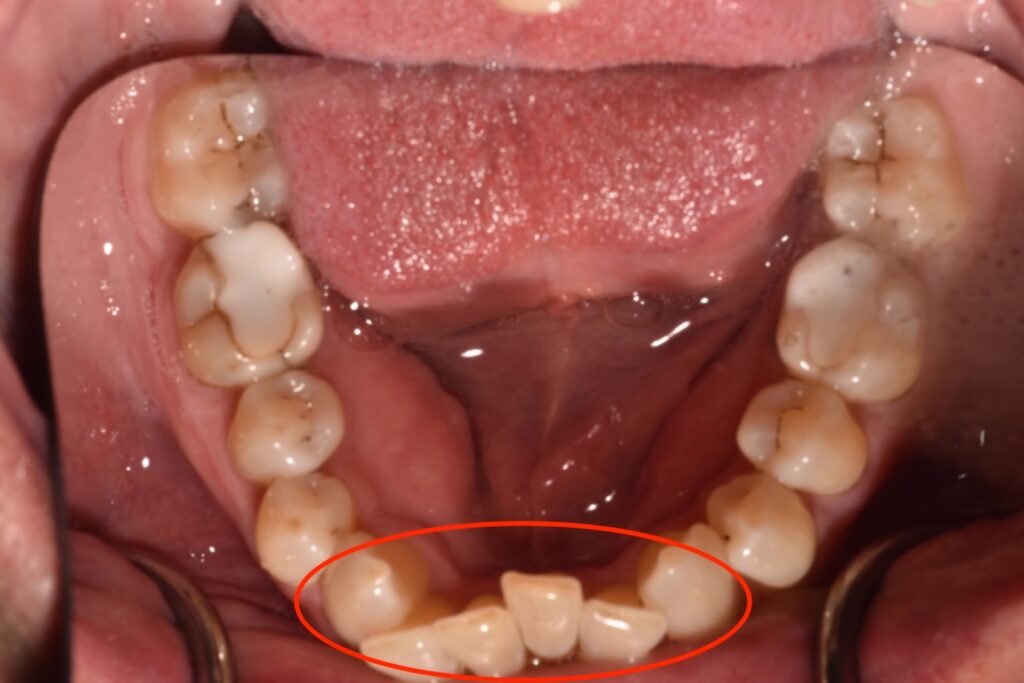 A birds eye view of a lower arch with severe mesial drift.
