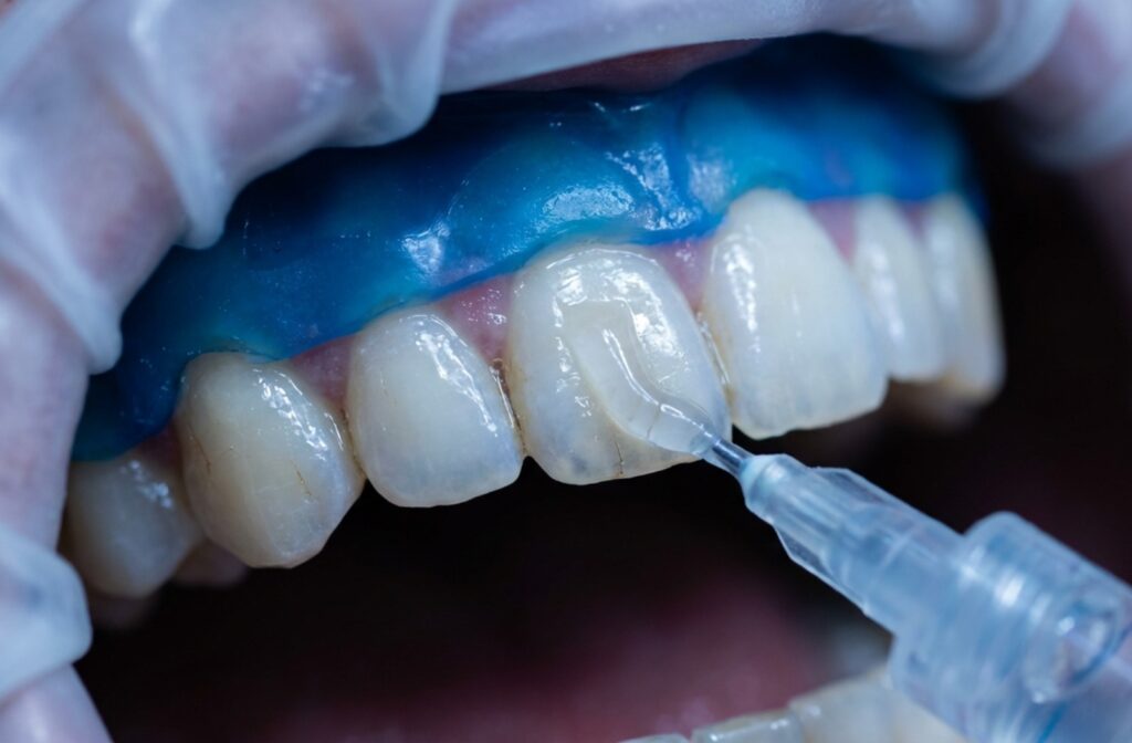 A close up of in-office teeth whitening at Cooper Dental, dentist in downtown Calgary.