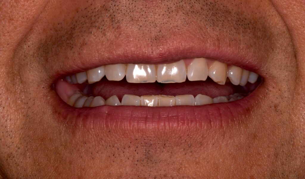 A close up of a dental patient's mouth showing moderate translucency on their front teeth.