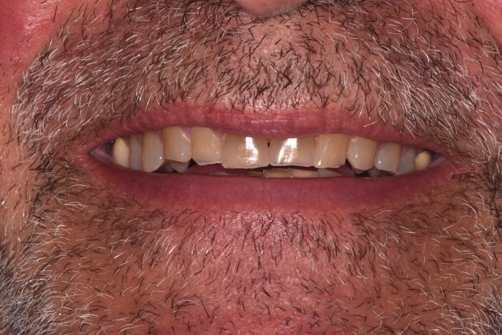 A close up of a patient's mouth showing severe translucency of the top 6 teeth.
