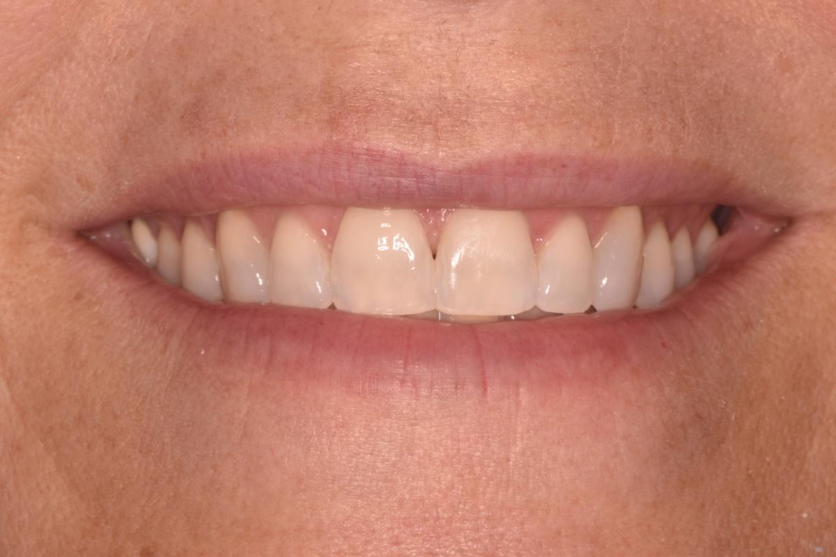 A smile of a patient at Cooper Dental in downtown Calgary after Invisalign treatment.