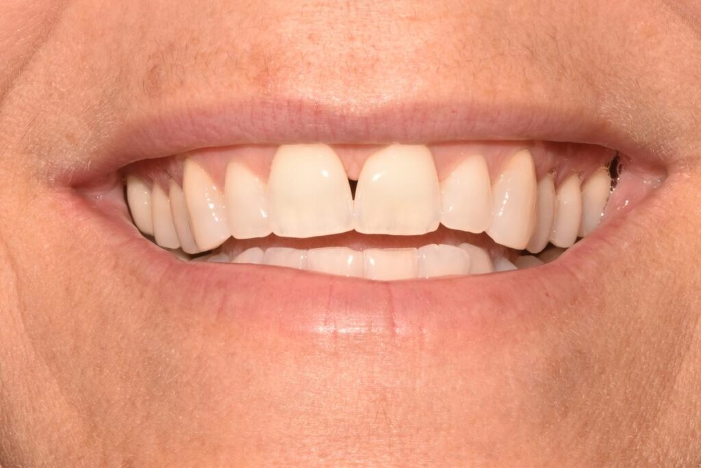 A smile of a patient at Cooper Dental in downtown Calgary before Invisalign treatment.