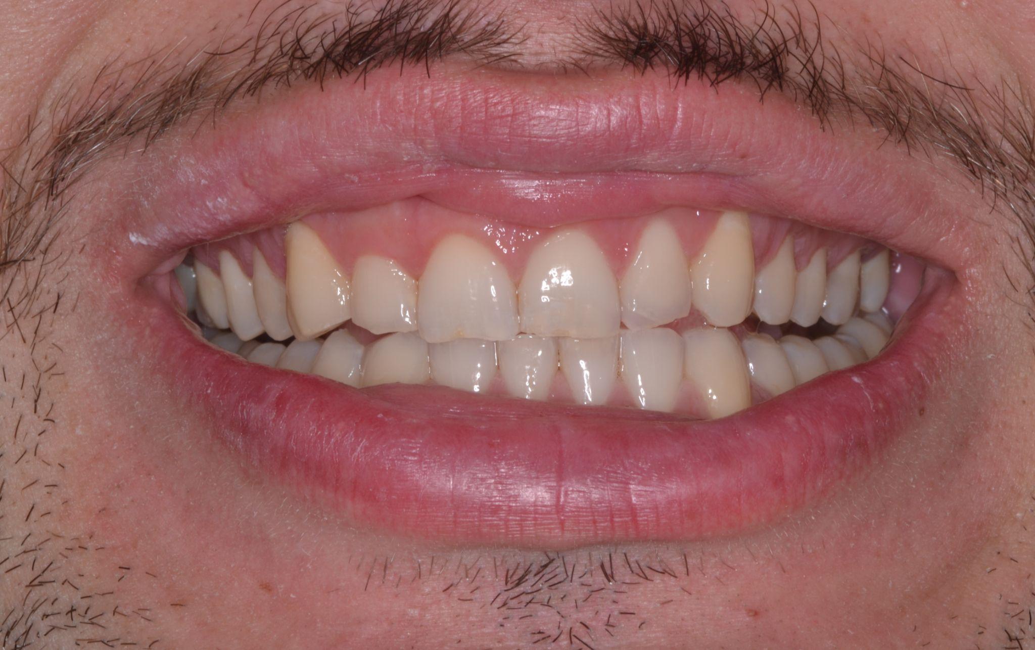A after Invisalign smile image of a patient at Cooper Dental in downtown Calgary.