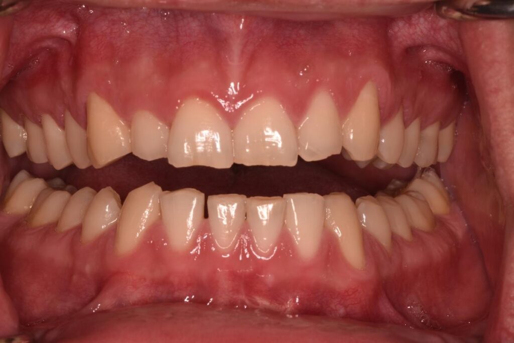 A before Invisalign image of a patient at Cooper Dental in downtown Calgary.