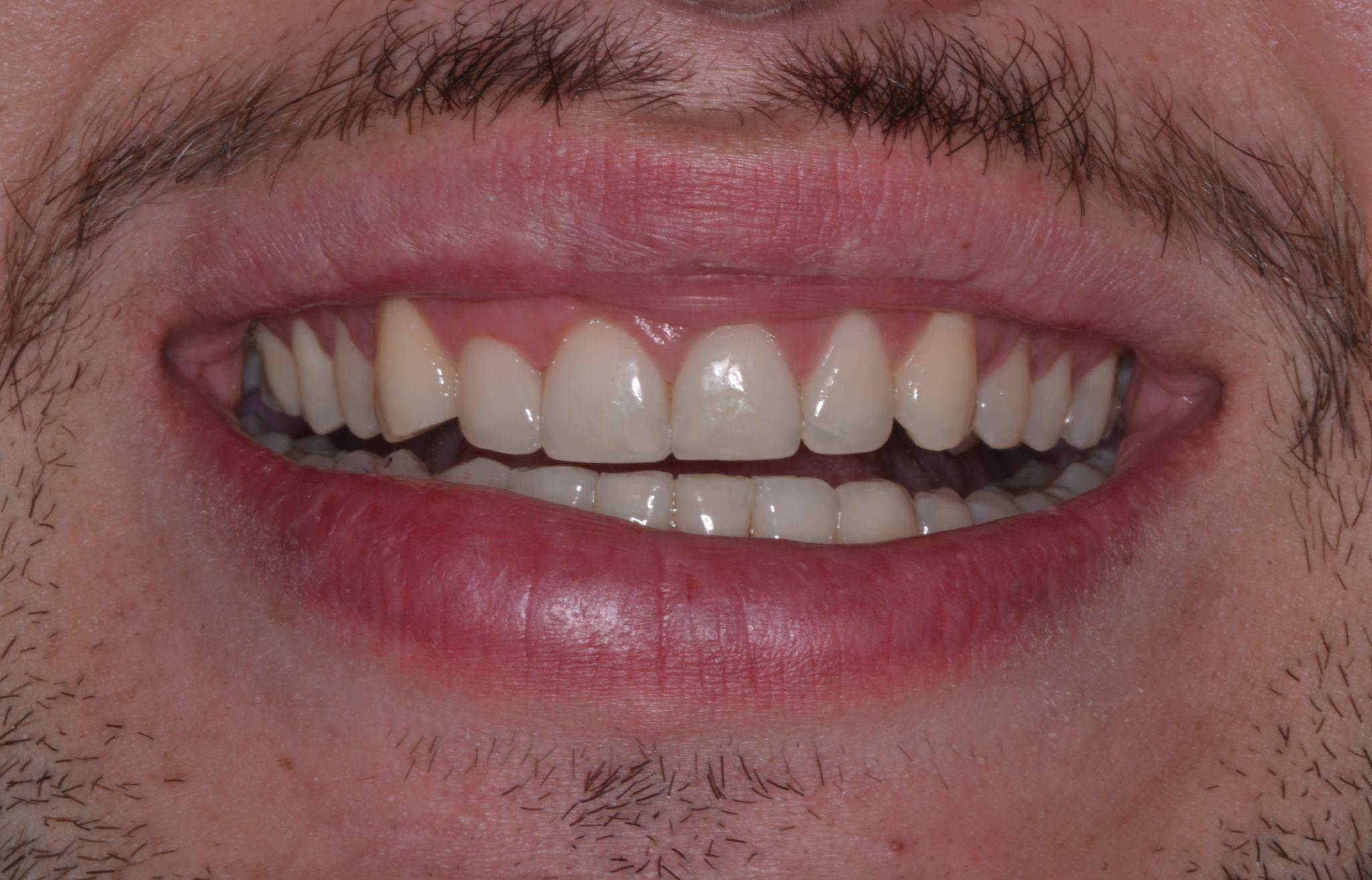 An after dental bonding image of a patient at Cooper Dental in downtown Calgary.