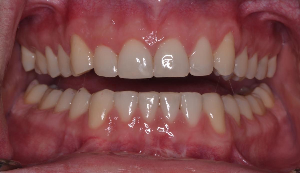 An after dental bonding image of a patient at Cooper Dental in downtown Calgary.