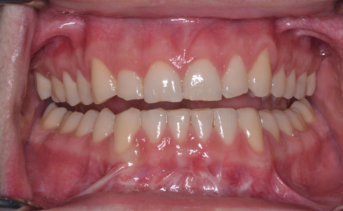An after Invisalign image of a patient at Cooper Dental in downtown Calgary.