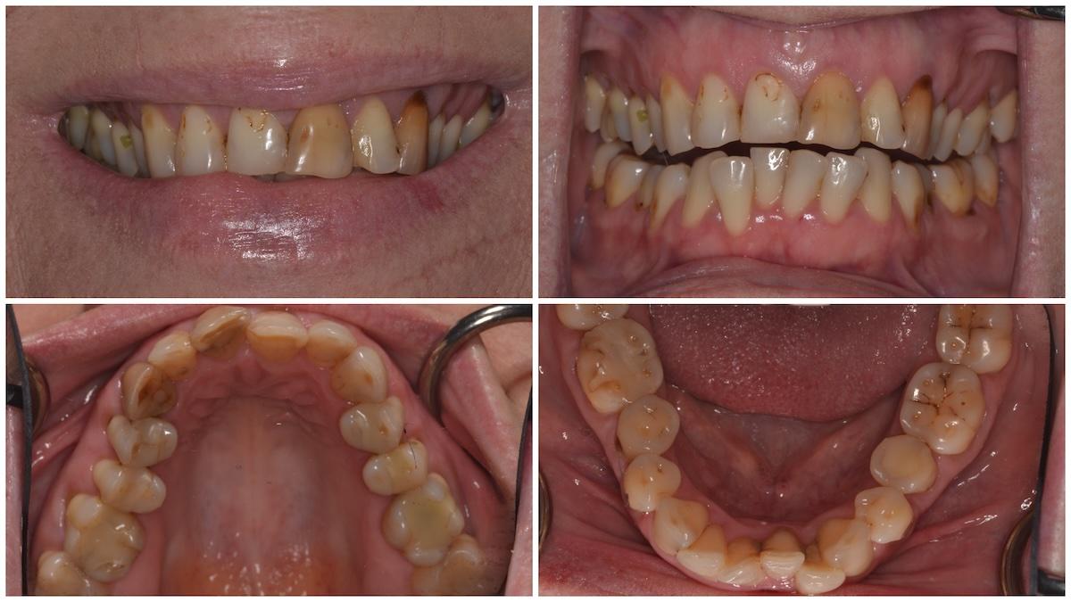4 views of the patient's teeth before treatment, showing misalignment and discolouration of the teeth.