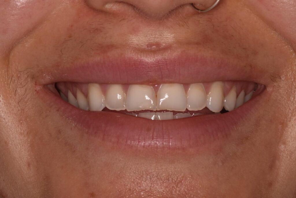 A before image showing a patient's teeth affected by dental erosion.