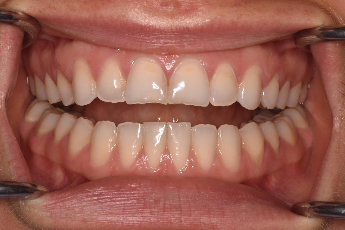 A close up of a patient's teeth affected by dental erosion.
