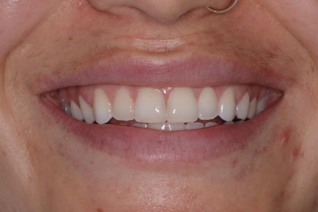 A close up of a patient's teeth restored after their smile transformation treatment at Cooper Dental in downtown Calgary.