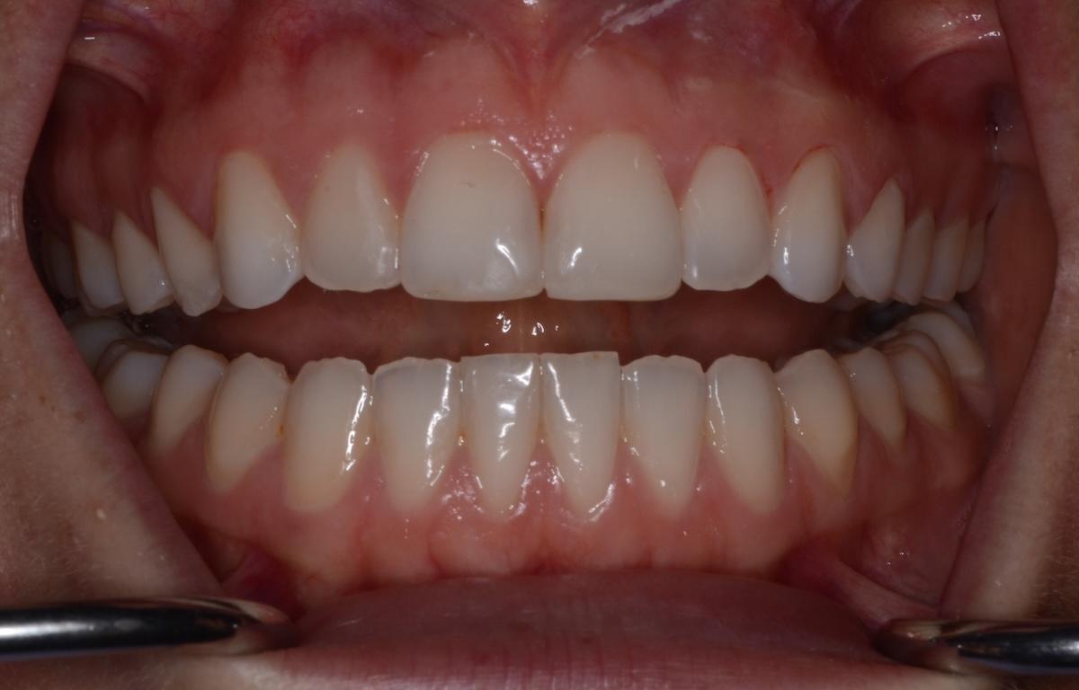 A close up of a restored smile after dental erosion.