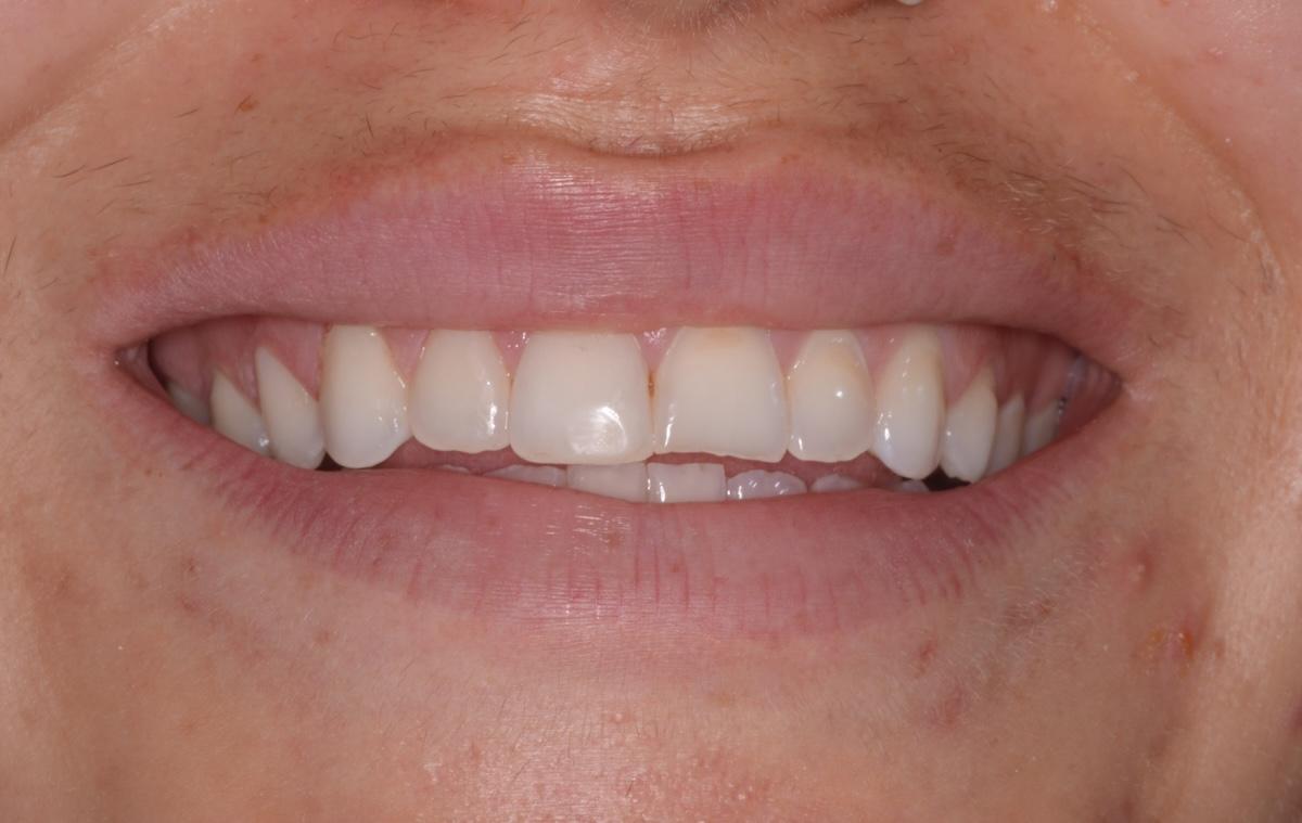A smile close up of the patient's teeth halfway through the treatment process.