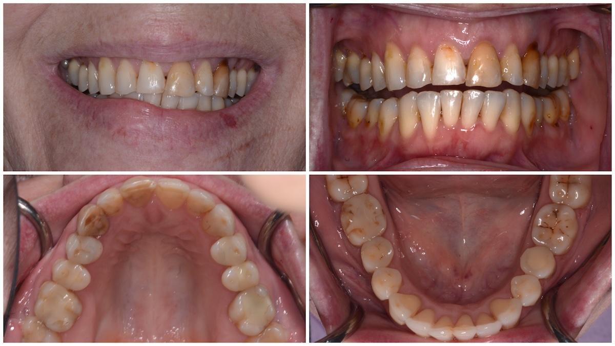 An after view of the patient's teeth after completing the Invisalign portion of treatment.